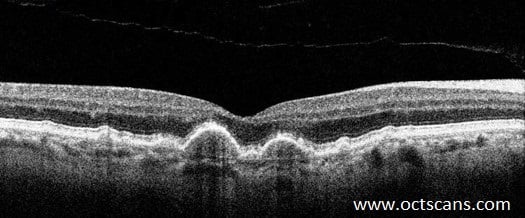 Macular Degeneration