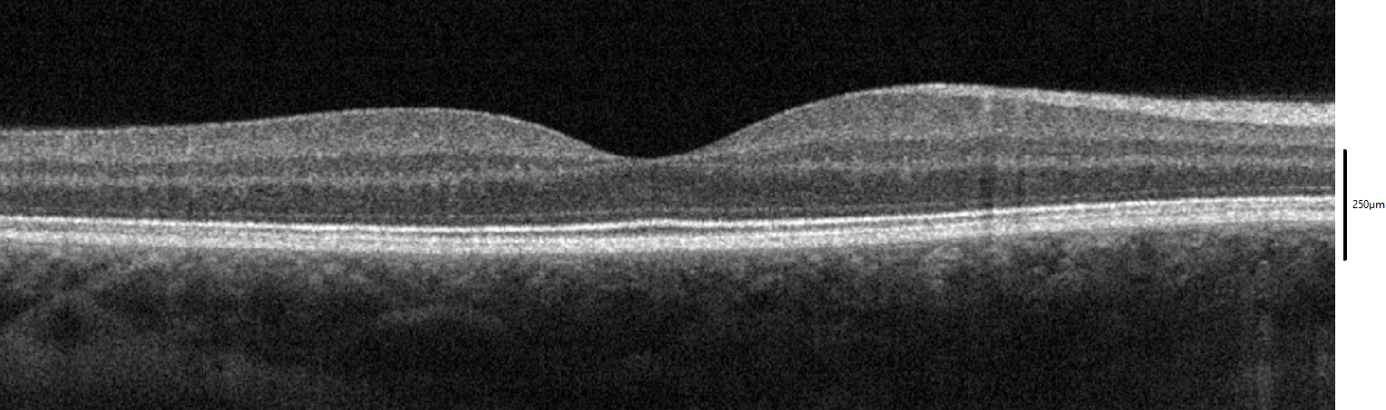 What is Optical Coherence Tomography